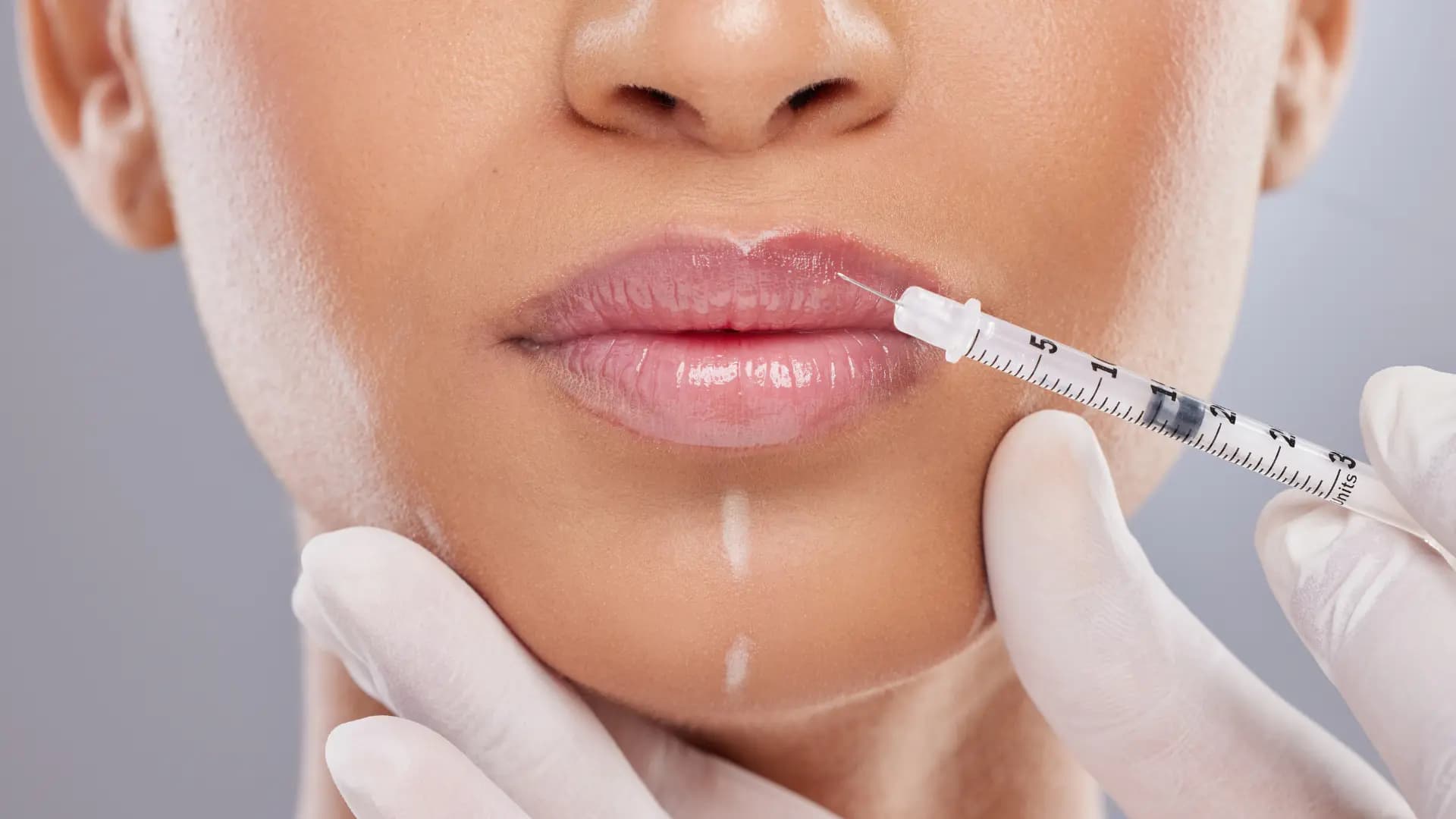 revolax filler – Hochwertige Dermal Filler bei MorySkin erhältlich