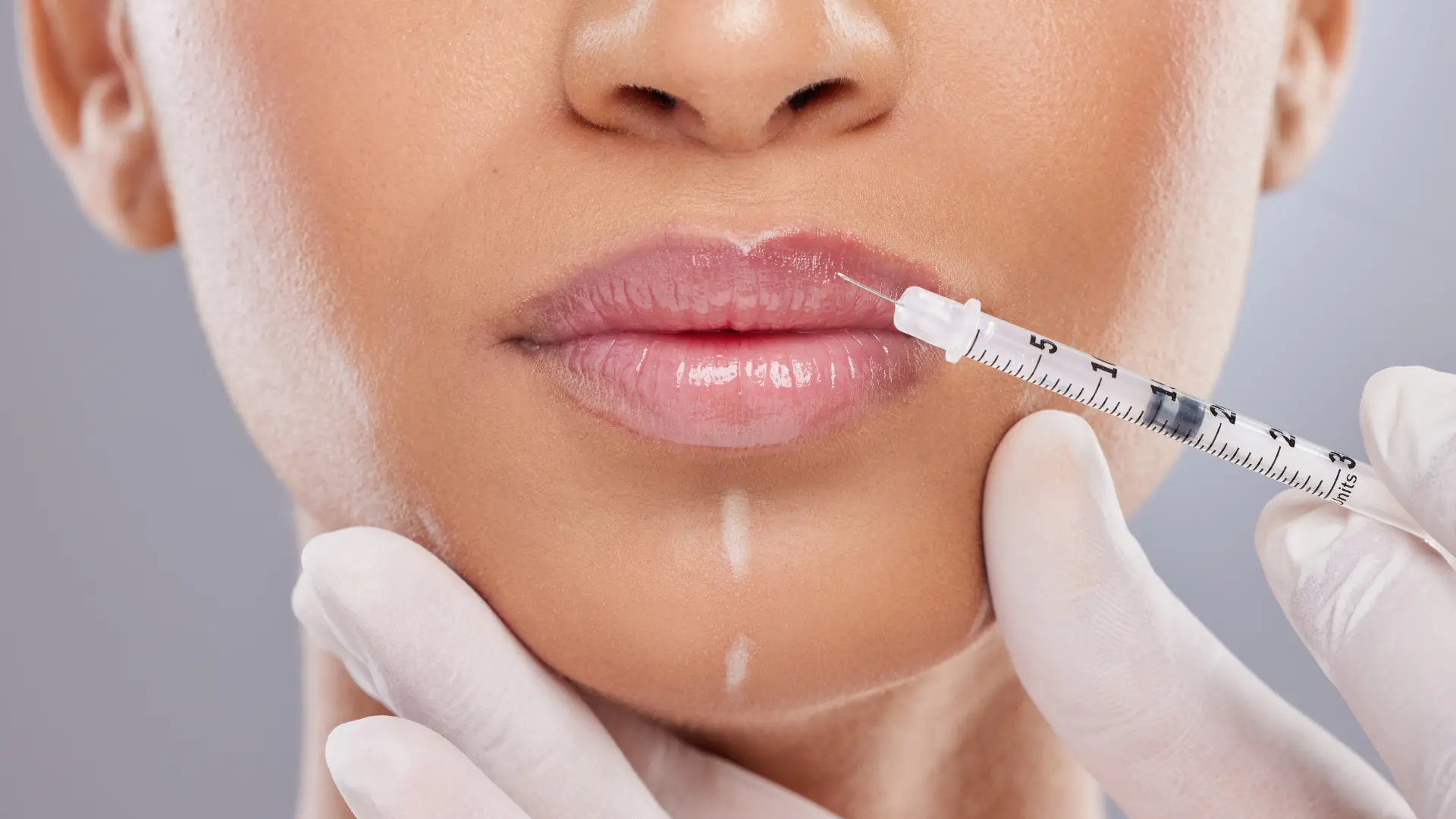 revolax filler – Hochwertige Dermal Filler bei MorySkin erhältlich